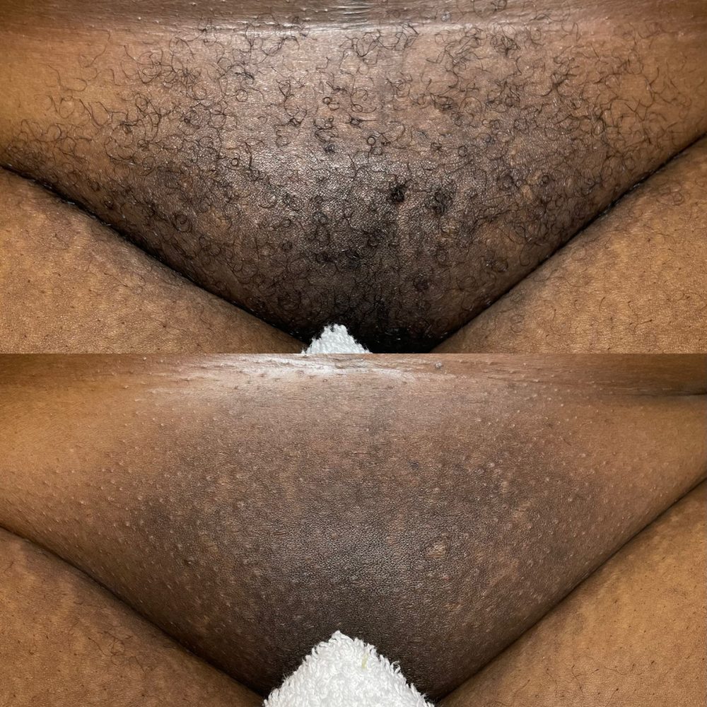 Brazilian Wax Las Vegas Before and After 1