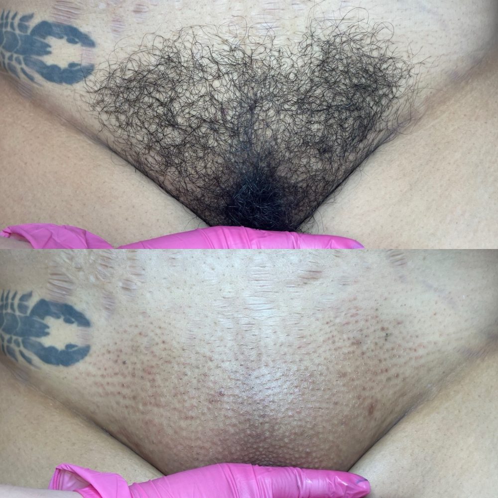 Brazilian Wax Las Vegas Before and After 10