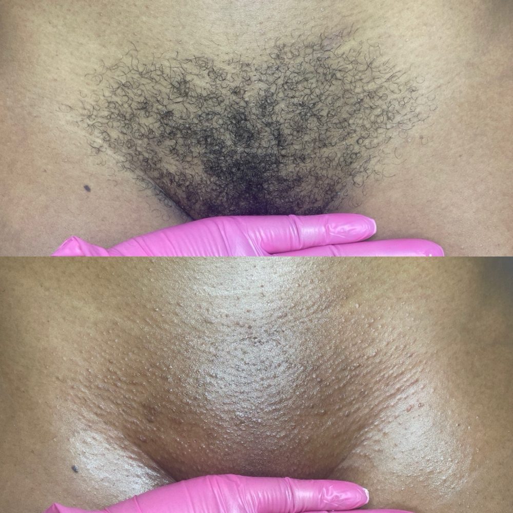 Brazilian Wax Las Vegas Before and After 12