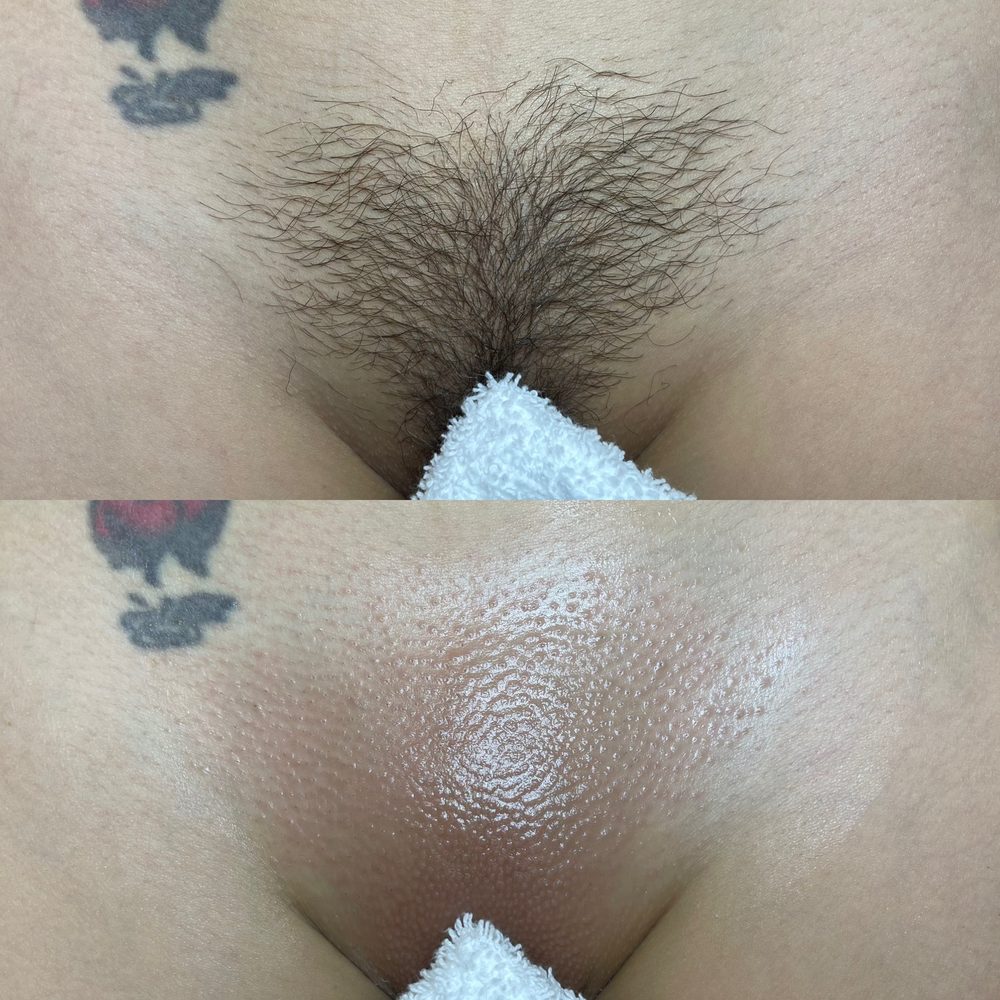 Brazilian Wax Las Vegas Before and After 13