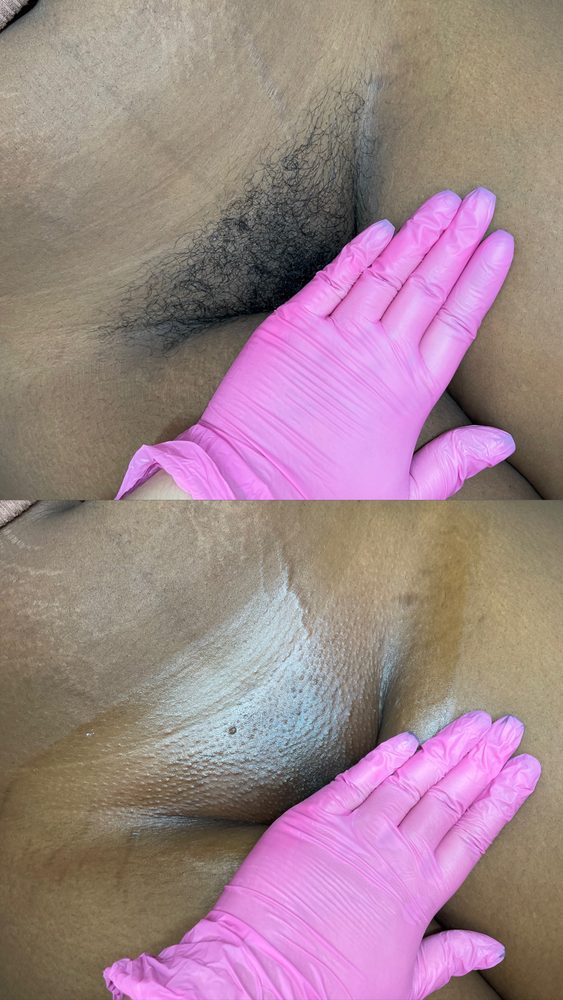 Brazilian Wax Las Vegas Before and After 14