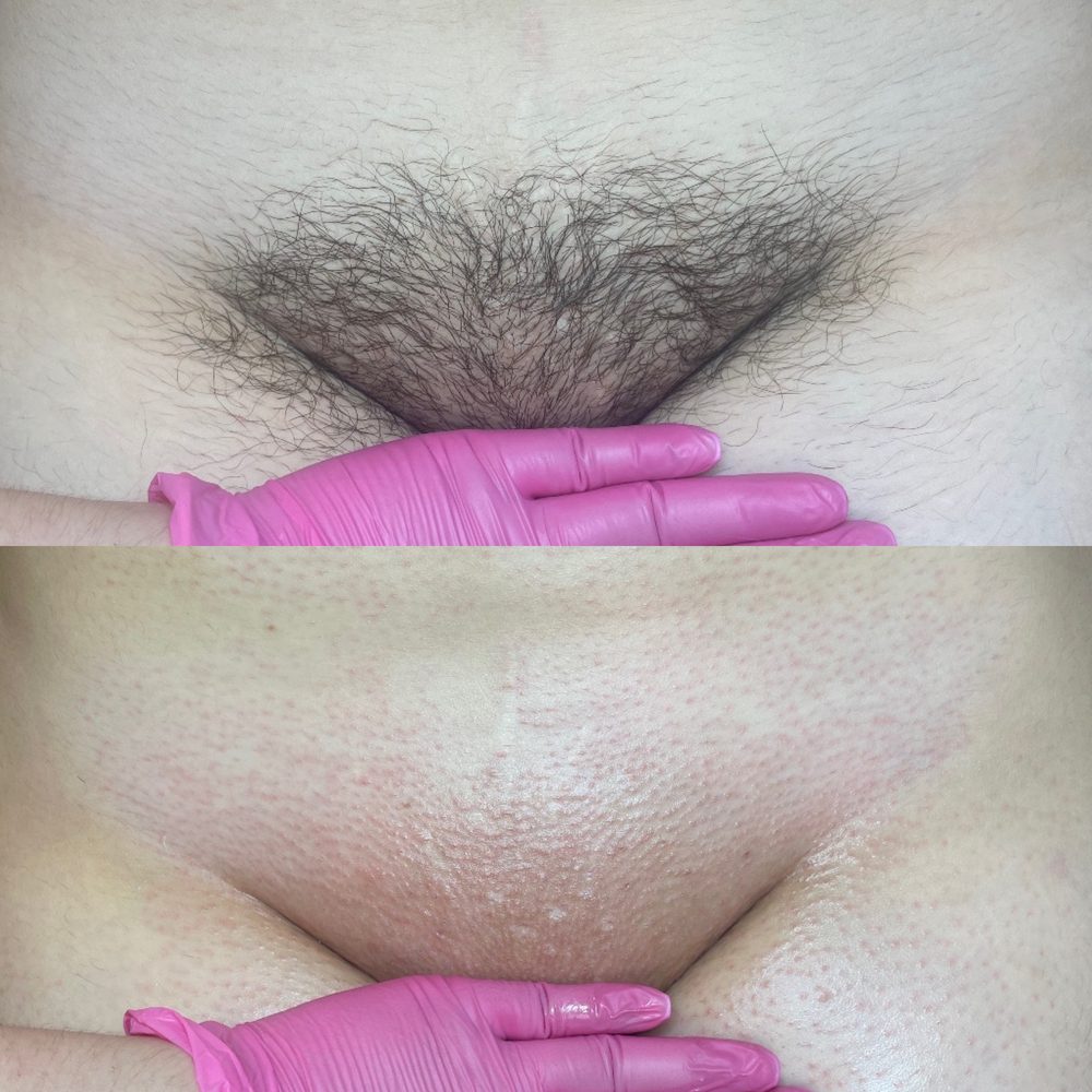 Brazilian Wax Las Vegas Before and After 15