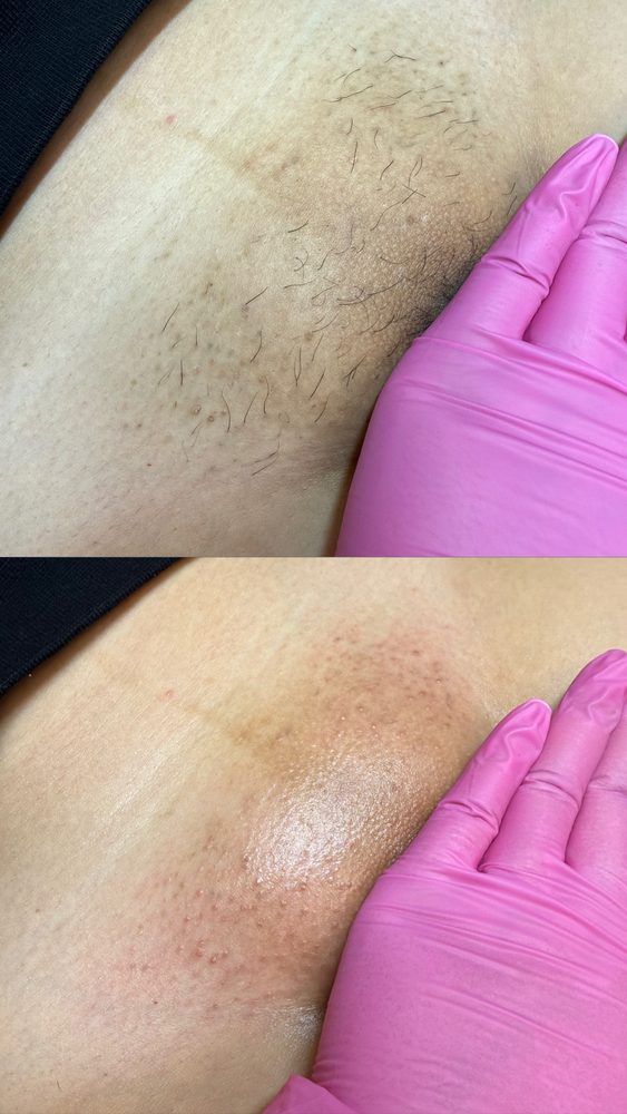 Brazilian Wax Las Vegas Before and After 16