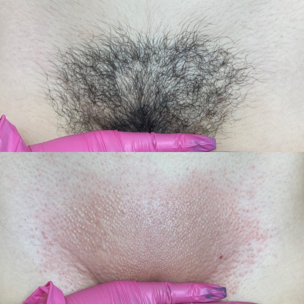Brazilian Wax Las Vegas Before and After 17
