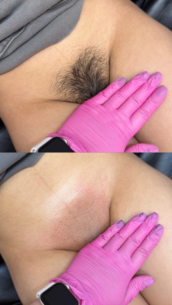 Brazilian Wax Las Vegas Before and After 18