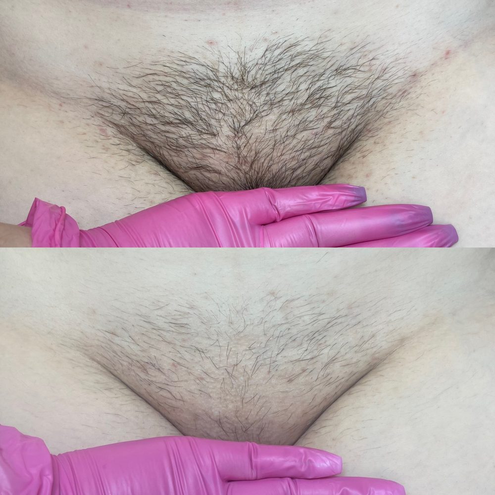 Brazilian Wax Las Vegas Before and After 19