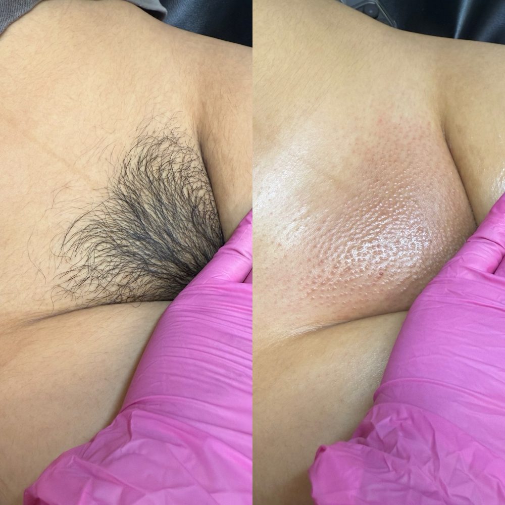 Brazilian Wax Las Vegas Before and After 2