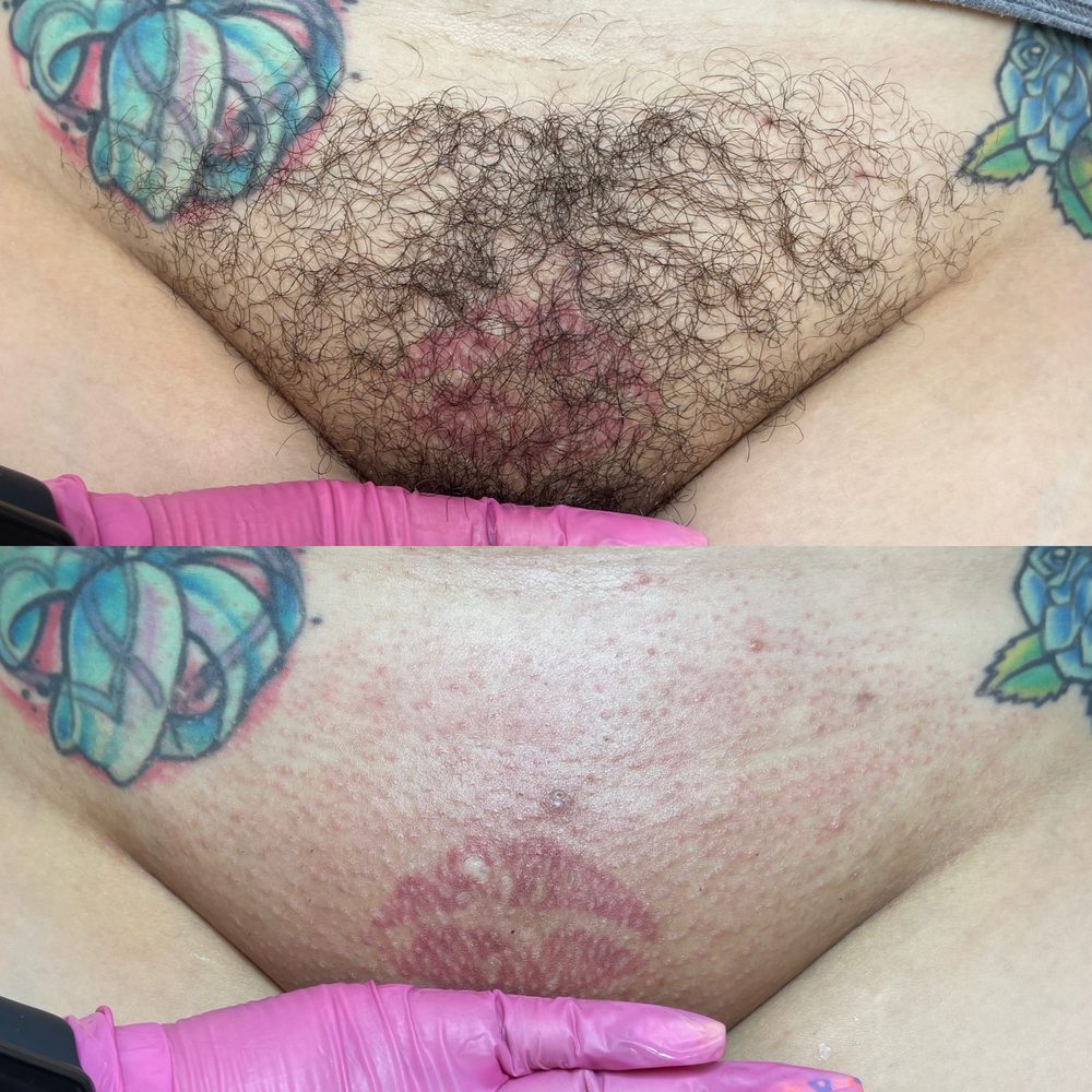 Brazilian Wax Las Vegas Before and After 20