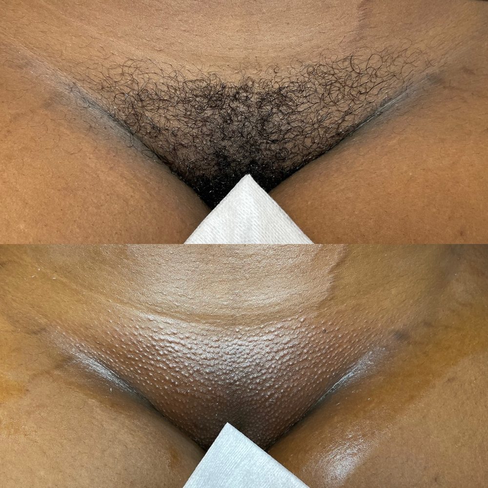 Brazilian Wax Las Vegas Before and After 21
