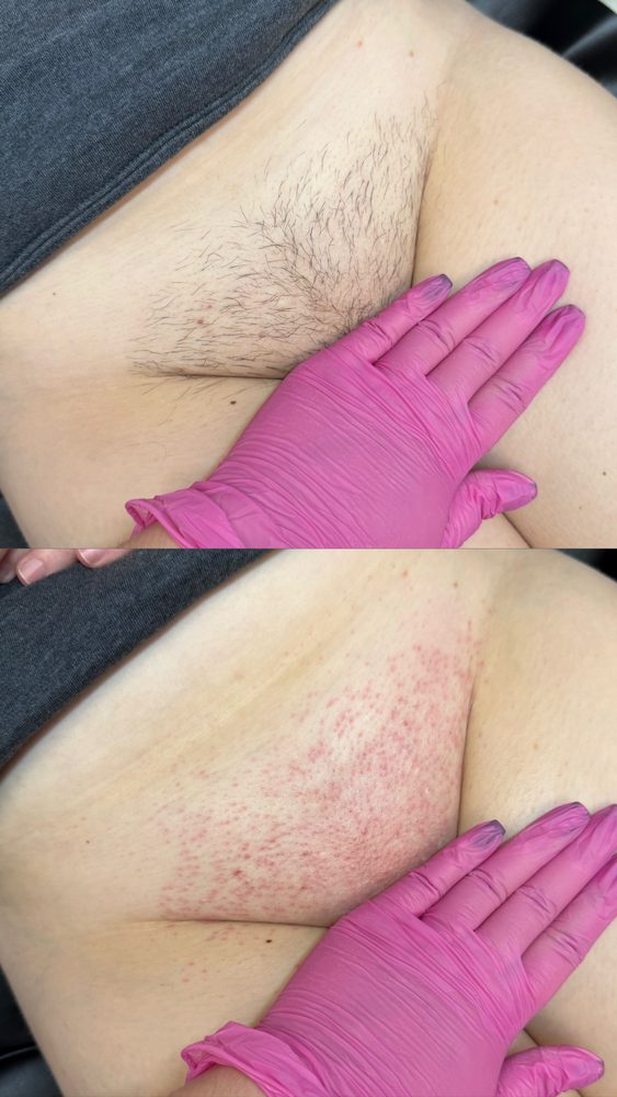 Brazilian Wax Las Vegas Before and After 22