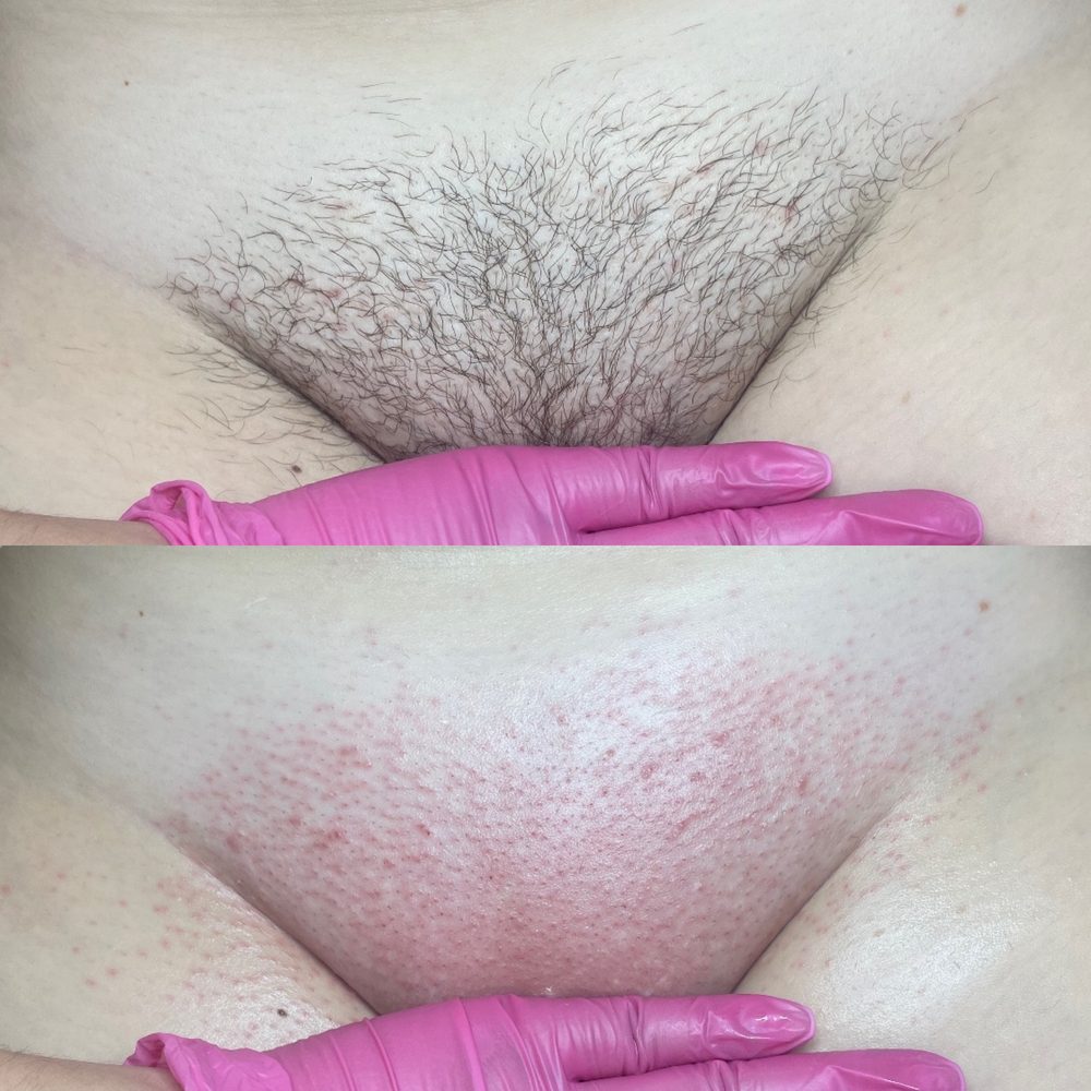 Brazilian Wax Las Vegas Before and After 23