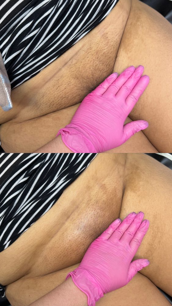 Brazilian Wax Las Vegas Before and After 24