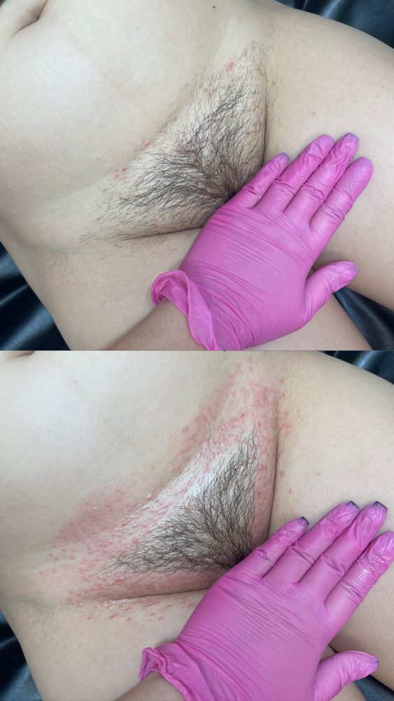Brazilian Wax Las Vegas Before and After 25