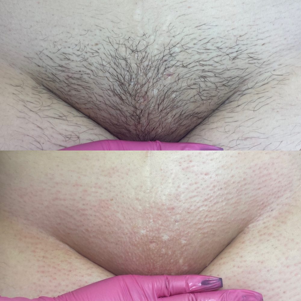 Brazilian Wax Las Vegas Before and After 26