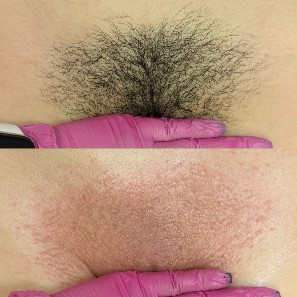 Brazilian Wax Las Vegas Before and After 27