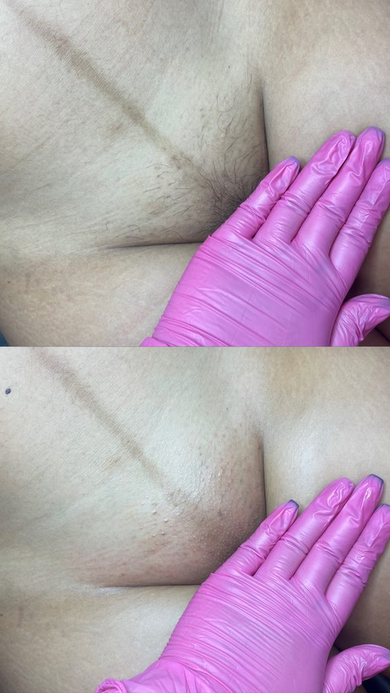 Brazilian Wax Las Vegas Before and After 28