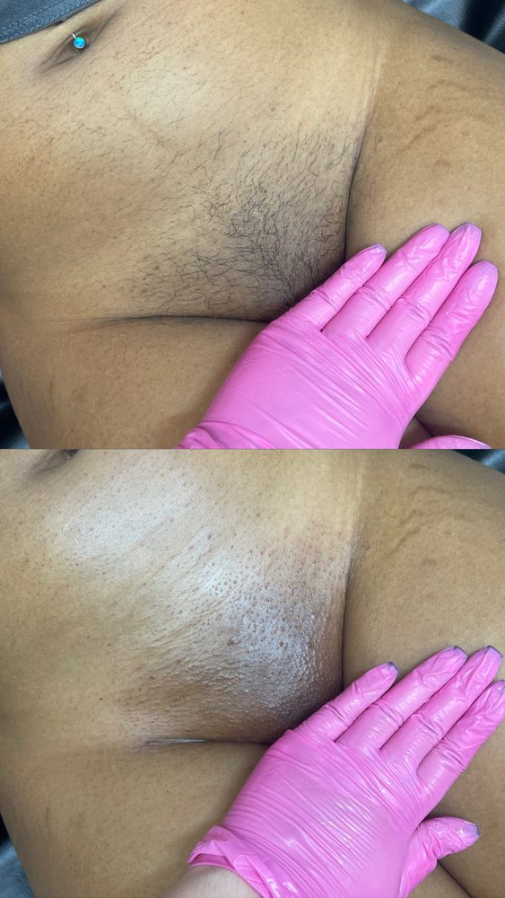 Brazilian Wax Las Vegas Before and After 29