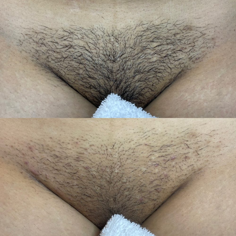 Brazilian Wax Las Vegas Before and After 30