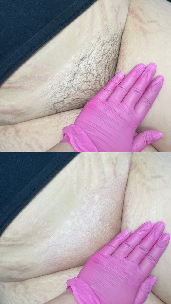 Brazilian Wax Las Vegas Before and After 31