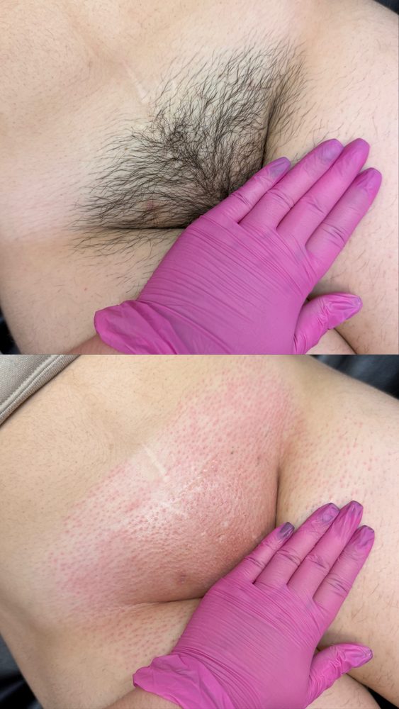 Brazilian Wax Las Vegas Before and After 32