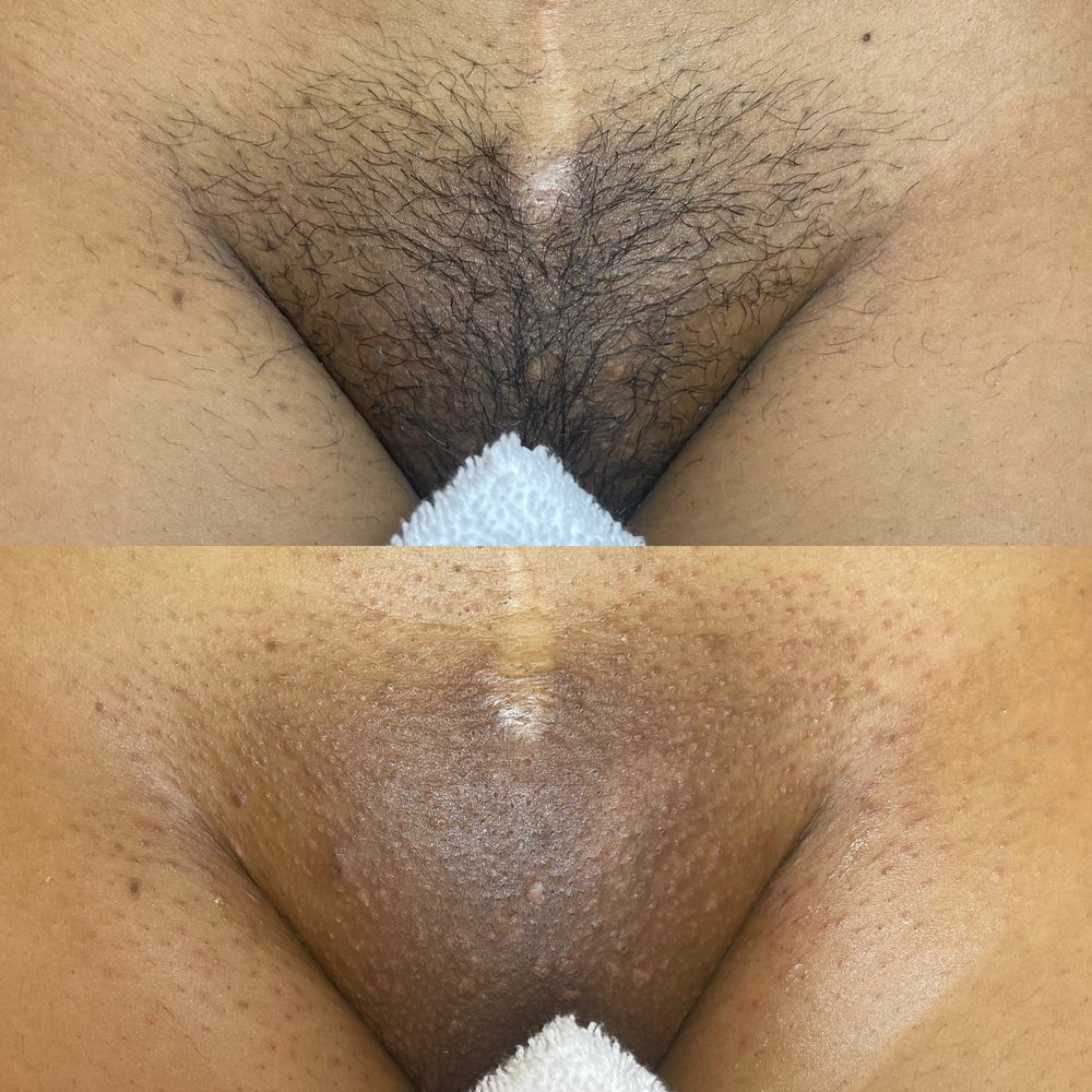 Brazilian Wax Las Vegas Before and After 33