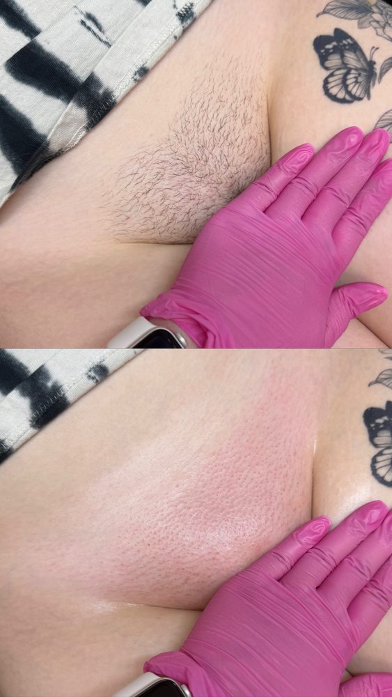 Brazilian Wax Las Vegas Before and After 34