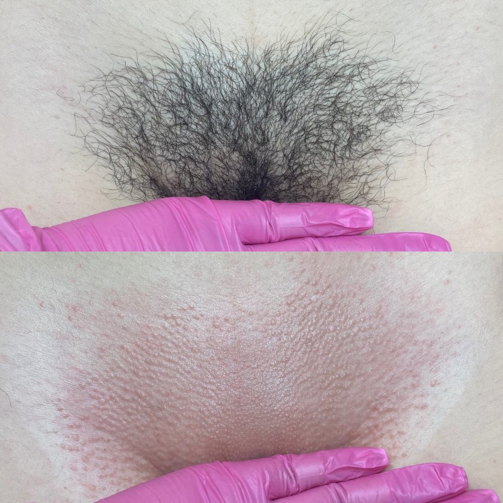Brazilian Wax Las Vegas Before and After 35