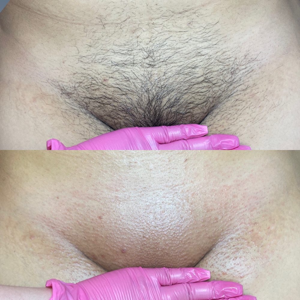 Brazilian Wax Las Vegas Before and After 36