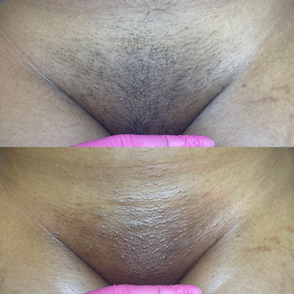 Brazilian Wax Las Vegas Before and After 37