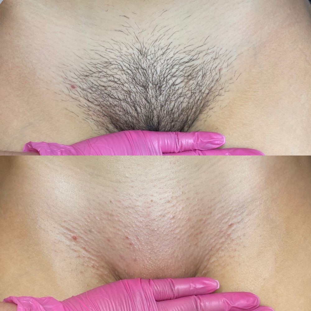 Brazilian Wax Las Vegas Before and After 38
