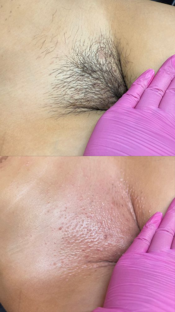 Brazilian Wax Las Vegas Before and After 39