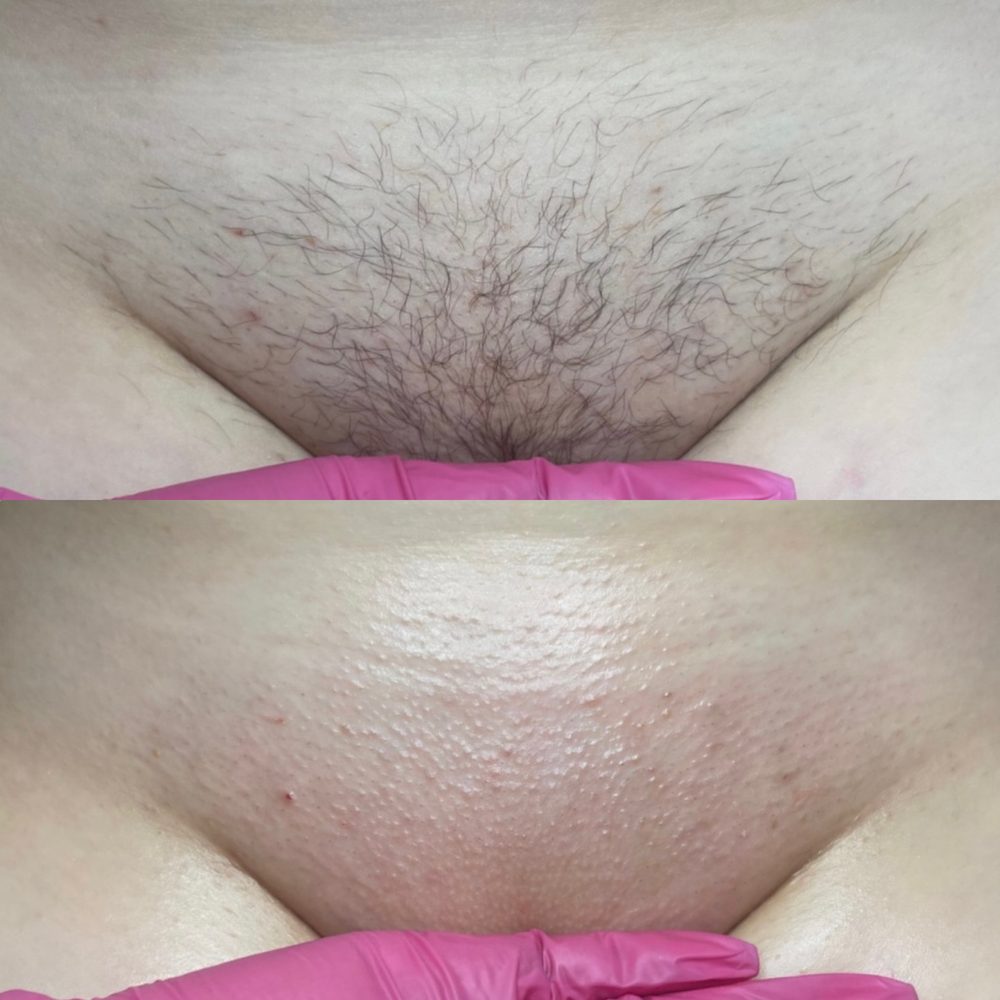Brazilian Wax Las Vegas Before and After 4