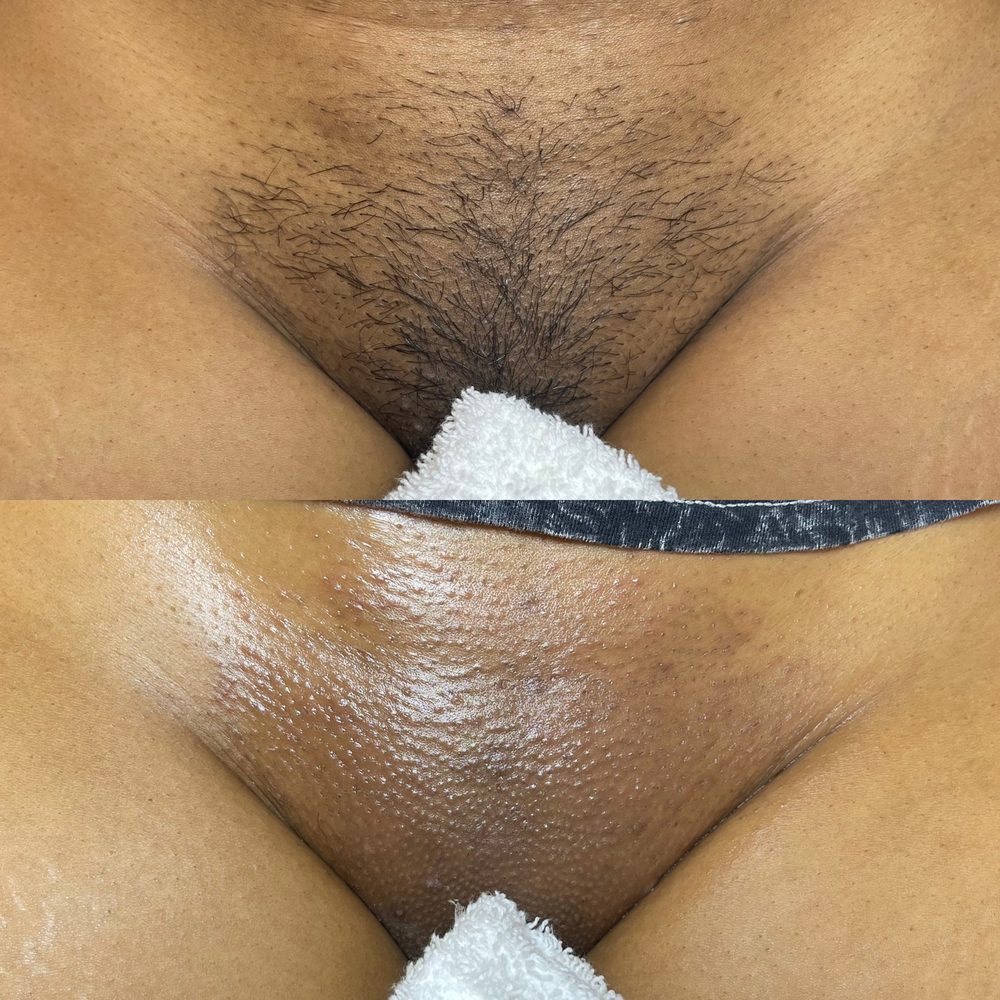 Brazilian Wax Las Vegas Before and After 40