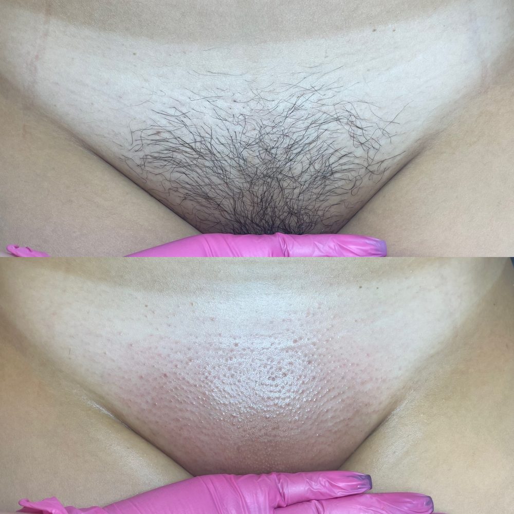 Brazilian Wax Las Vegas Before and After 41