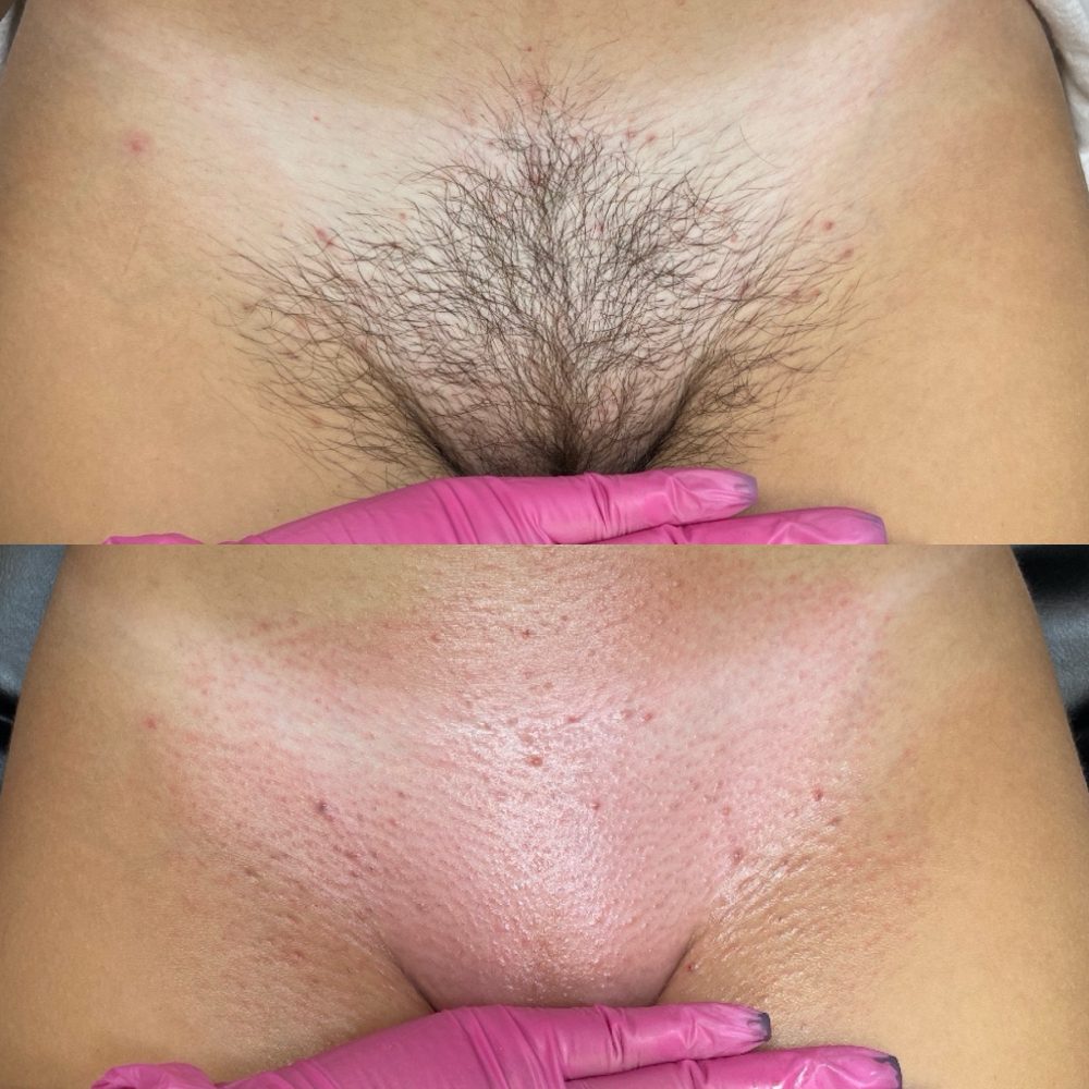 Brazilian Wax Las Vegas Before and After 5