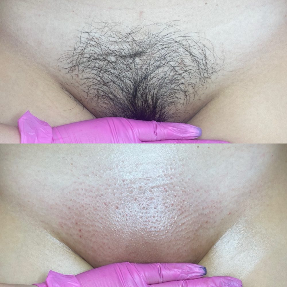 Brazilian Wax Las Vegas Before and After 6