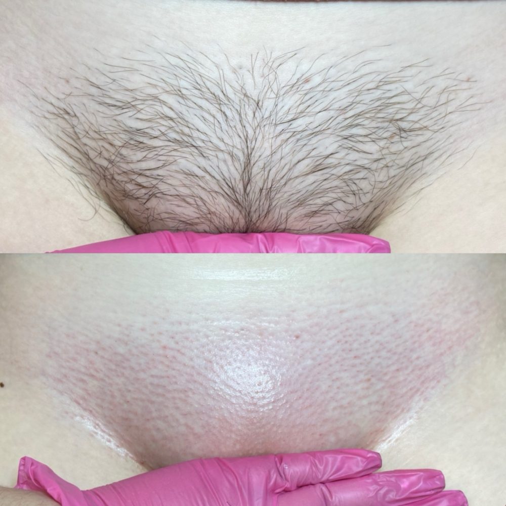 Brazilian Wax Las Vegas Before and After 8