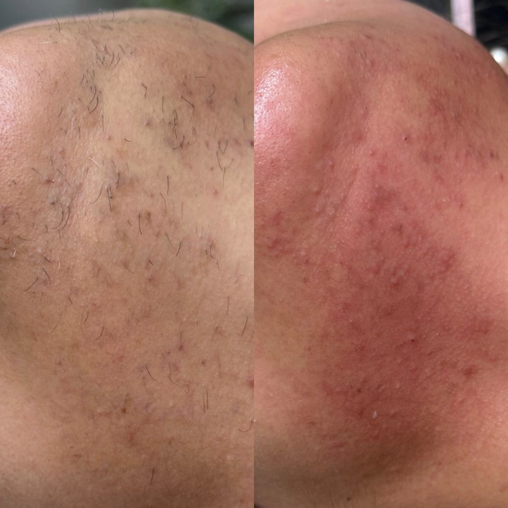 Chin Wax Las Vegas 1