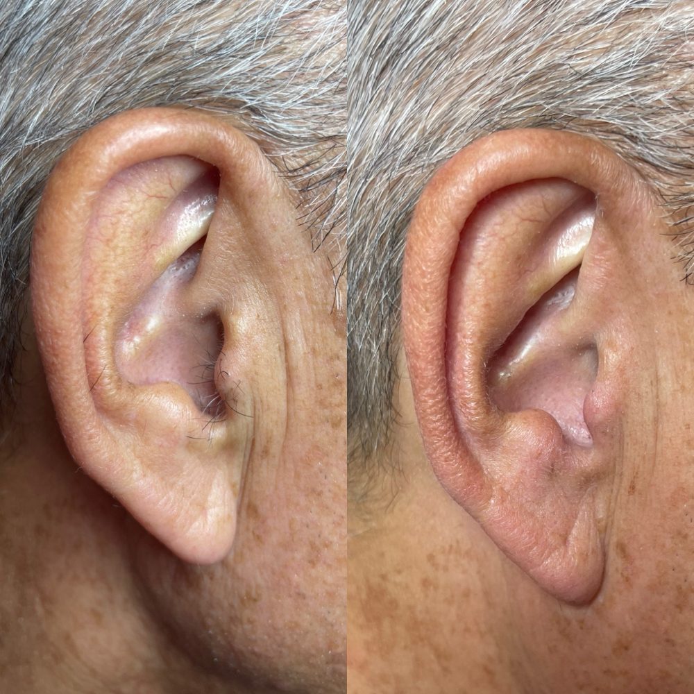 Ear Wax Las Vegas