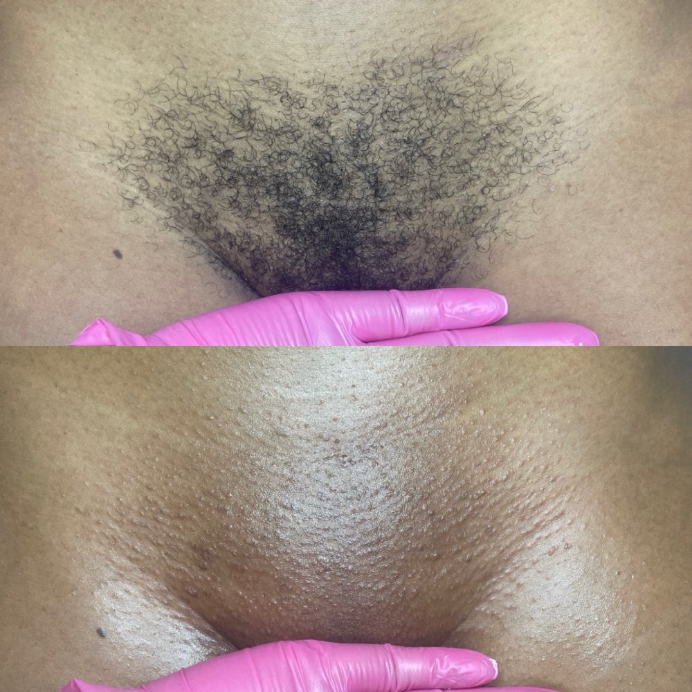 Brazilian wax Las Vegas: before and after a comfort Brazilian wax with hard wax at Pink Crab Wax Bar