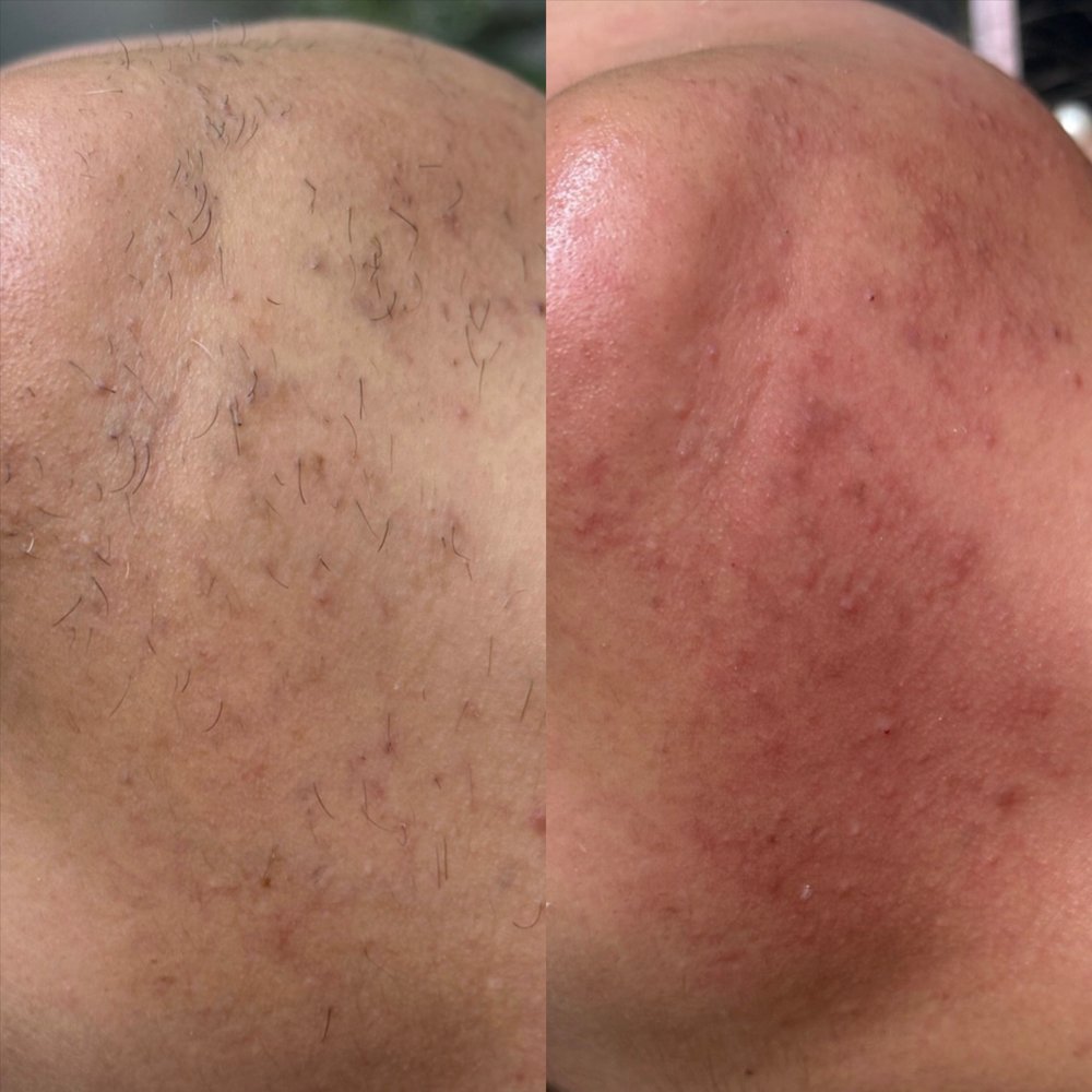 Chin wax Las Vegas: chin and jawline before and after a hard wax at Pink Crab Wax Bar