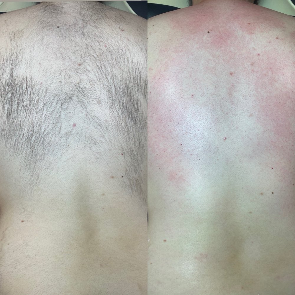 Back wax Las Vegas: before and after a full back wax at Pink Crab Wax Bar