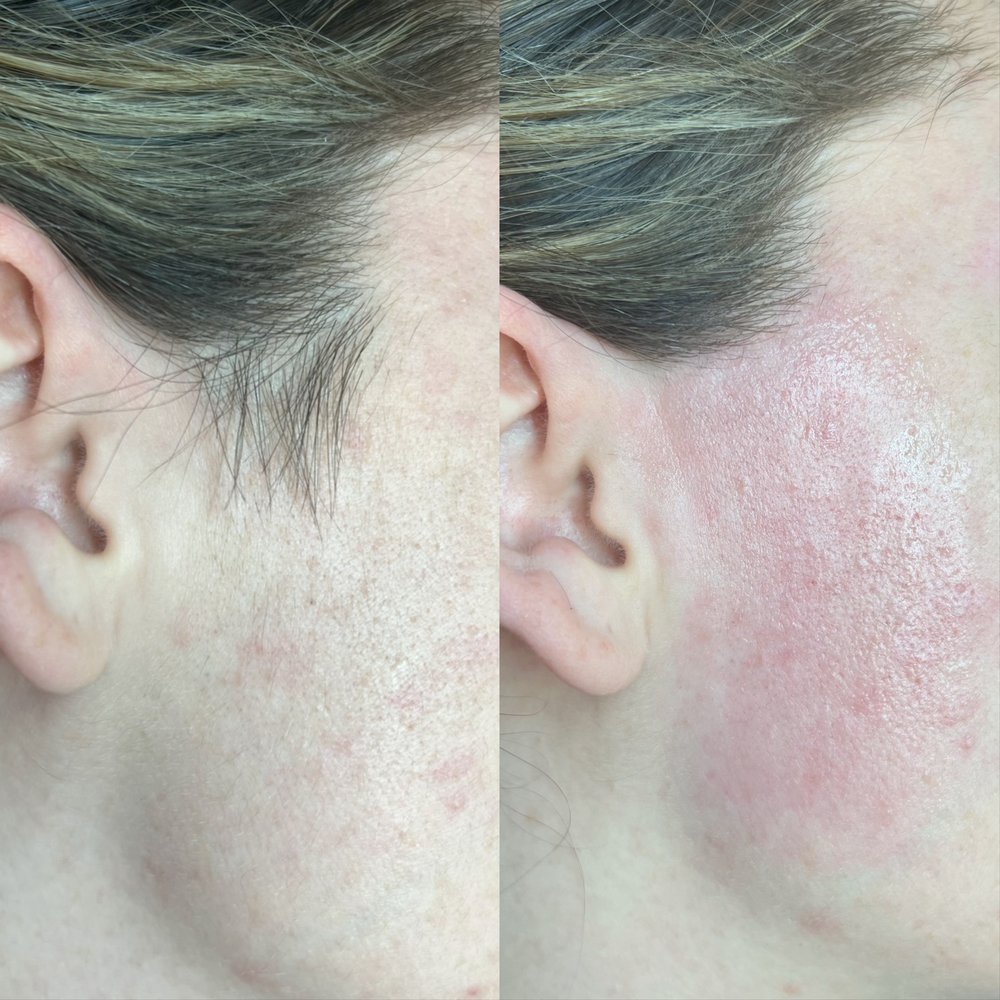 Full face wax Las Vegas: cheek and sideburn area before and after hard wax at Pink Crab Wax Bar