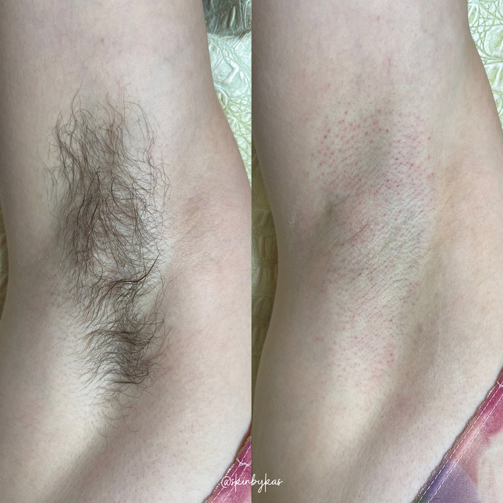 Underarm wax Las Vegas: before and after an armpit wax with hard wax at Pink Crab Wax Bar